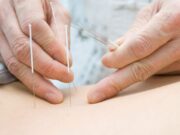 Рефлексотерапия в медицине