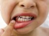 Гингивит у детей