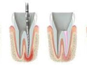 Этапы лечения зубов