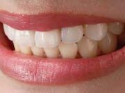 Виды художественной реставрации зубов