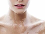 Болезнь Витилиго: причины и лечение