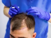 Как проходит пересадка волос в клинике HAIR&SKIN ?