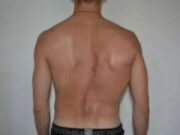 Берут ли в армию с искривлением позвоночника?