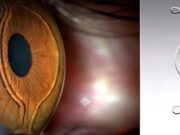 Имплантация факичных линз: позволяет сохранить природный хрусталик глаза и вернуть остроту зрения