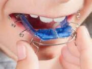 Пластины для выравнивания зубов у детей