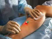 Как происходит лазерное удаление варикоза?