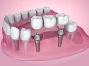 Варианты имплантации зубов