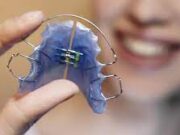 Пластины для выравнивания зубов у детей