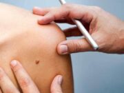 Бородавки. Как с ними бороться