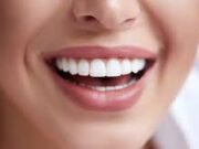 Виды отбеливания зубов