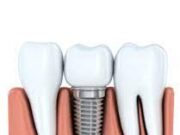 Имплантация зубов: современный метод восстановления утраченных зубов