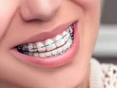 Как правильно подготовиться к установке брекетов?