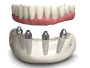 Технология имплантации All-on-4