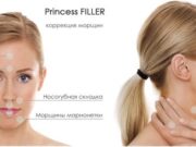 Преимущества филлеров Принцесс