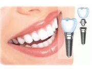 Почему важна имплантация зубов?