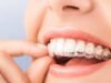 Элайнеры для зубов: особенности использования