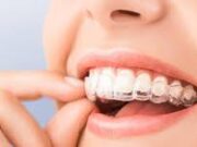Элайнеры для зубов: особенности использования