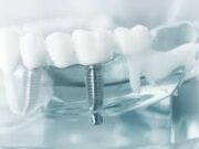 Имплантация зубов: что нужно знать?