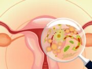 Вульвовагинальный кандидоз: симптомы, диагностика, лечение