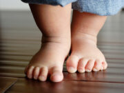 Правильная реабилитация после лечения врожденной косолапости у детей