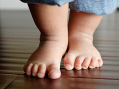 Правильная реабилитация после лечения врожденной косолапости у детей