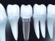 Имплантация зубов в «Dental Effect»