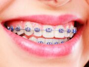 Какие виды брекетов бывают?