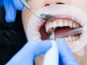 Профессиональная гигиена полости рта стоматологии