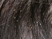 Как понять, что у тебя появились вши