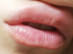 Методы удаления гранул Фордайса