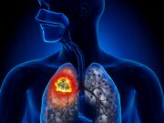 Появились признаки рака легкого: что предпринять и куда обратиться?