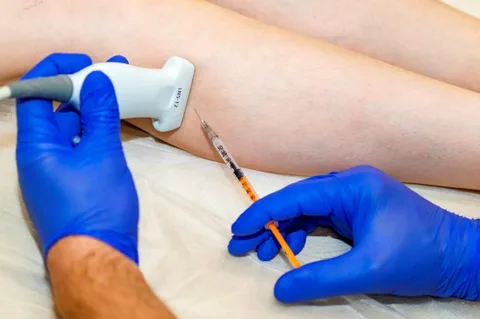 Как проходит процедура склеротерапии варикозных вен?