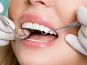 Современные методы реставрации зубов