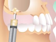 Синус лифтинг в стоматологии