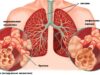 Что такое эмфизема легких и как ее лечить?
