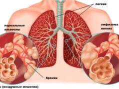 Что такое эмфизема легких и как ее лечить?
