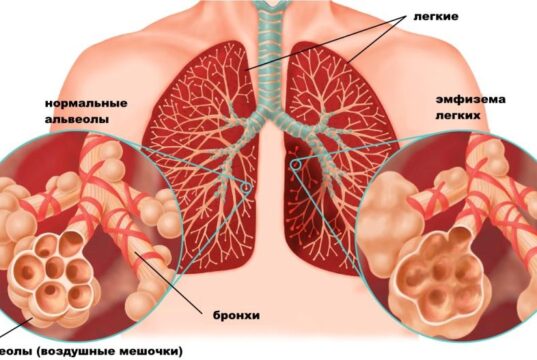 Что такое эмфизема легких и как ее лечить?