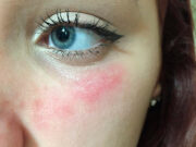 Виды и симптомы аллергии