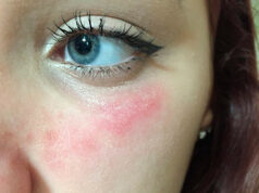 Виды и симптомы аллергии