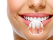Имплантация зубов в стоматологии Prime Smile