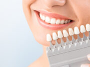 Установка керамических виниров: отличный способ восстановления улыбки