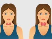 Гомеопатическое лечение гипотиреоза