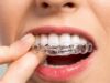 Достоинства прозрачных брекетов