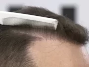 Пересадка волос методом FUE