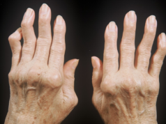 Причины возникновения и развития артрита