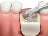Костная пластика при имплантации зубов