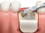 Костная пластика при имплантации зубов