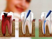 Как происходит лечение периодонтита?