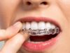 Как работают брекеты для выравнивания зубов?