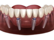 Что представляет собой имплантация All-on-4?